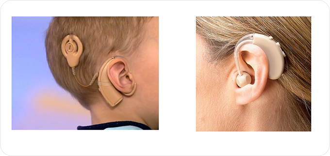 Кохлеарный имплантат и слуховой аппарат